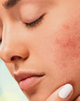 Rosacea & Acne - Laser