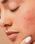 Rosacea & Acne - Laser