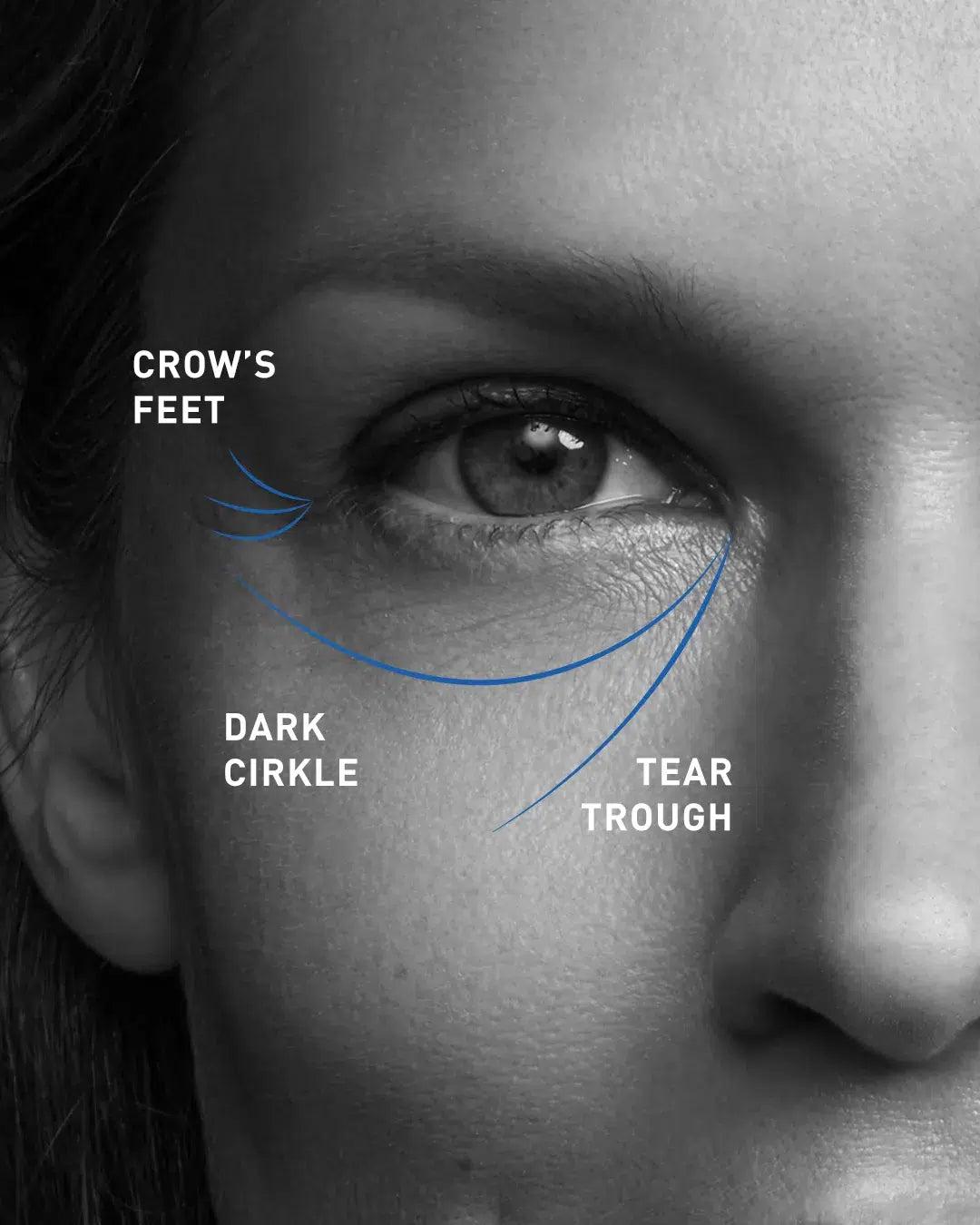 Restylane Tear Through